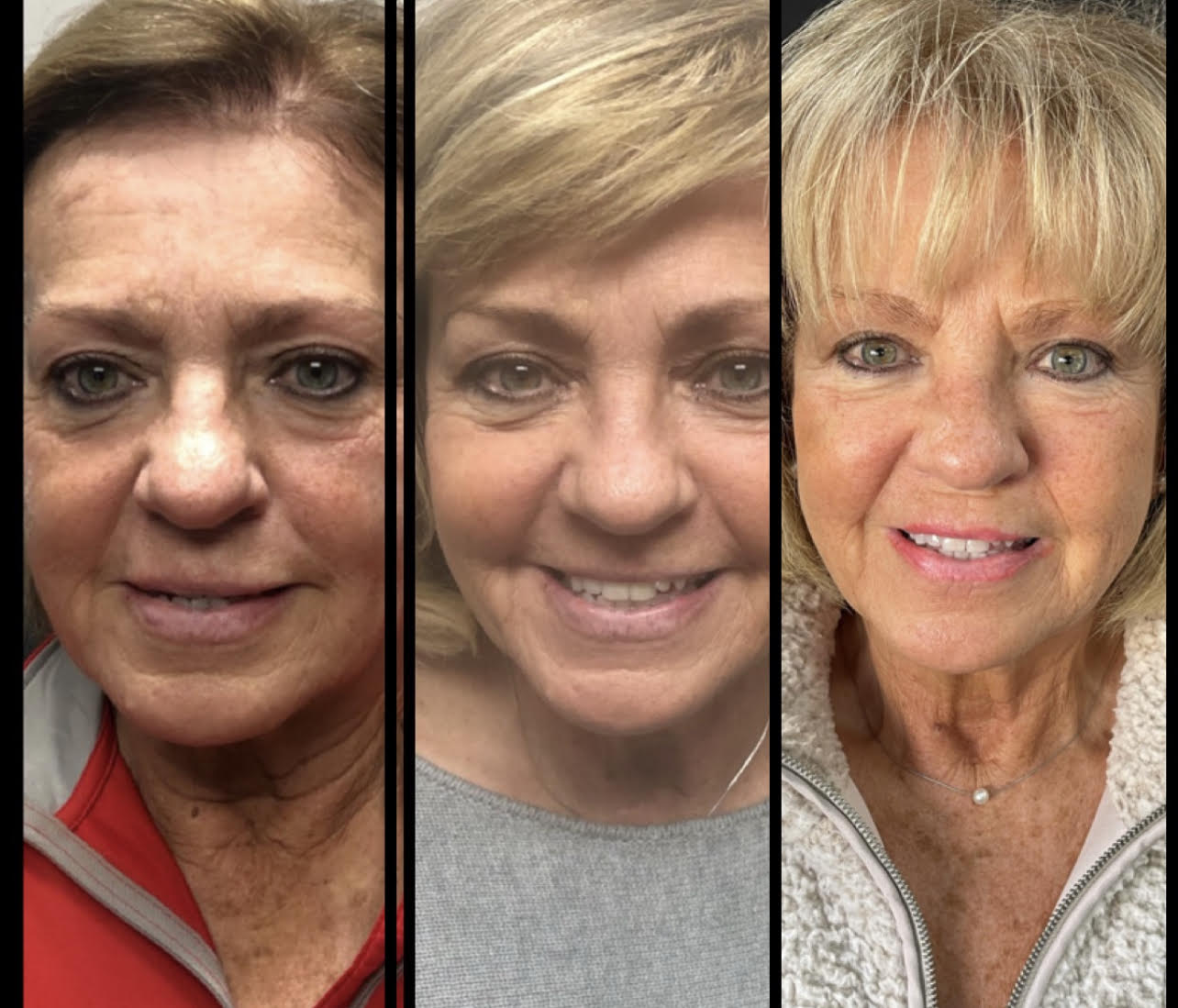 sculptra results