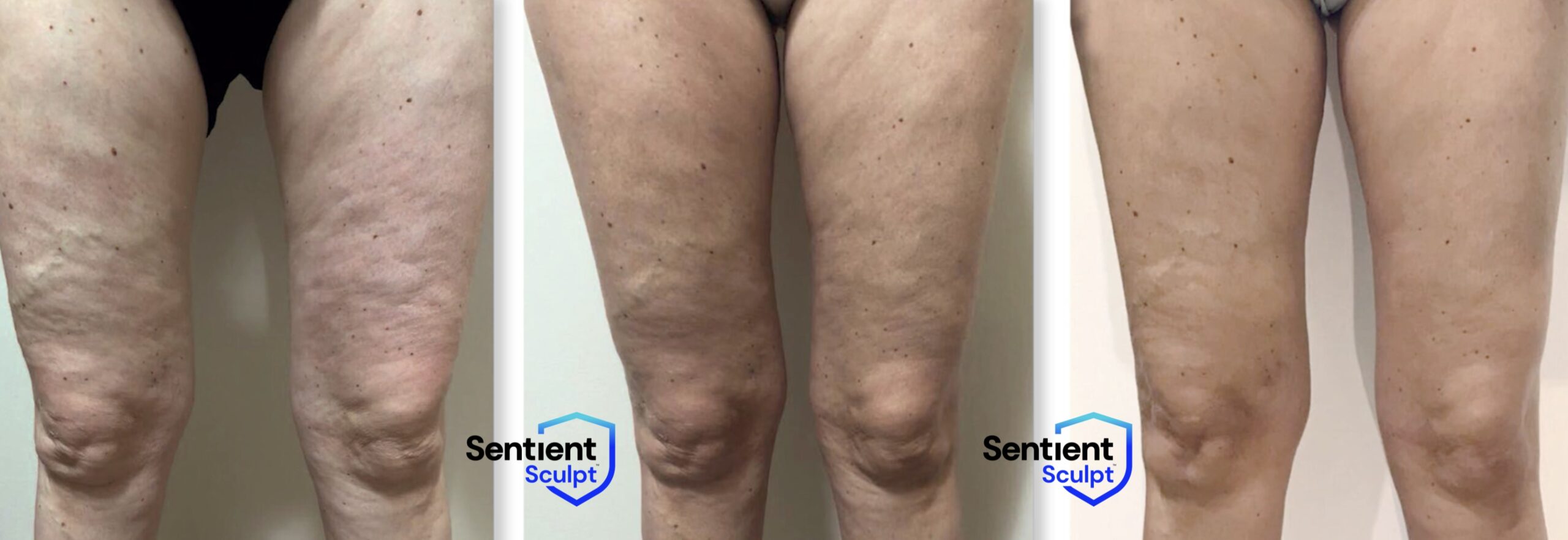 Sculpt by Sentient – Skin Retouch MediSpa